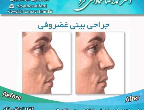 جراحی بینی غضروفی