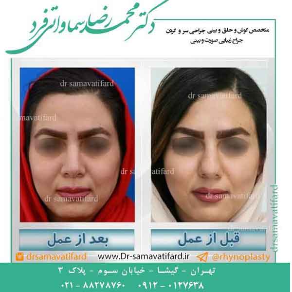 متخصص جراحی بینی در تهران